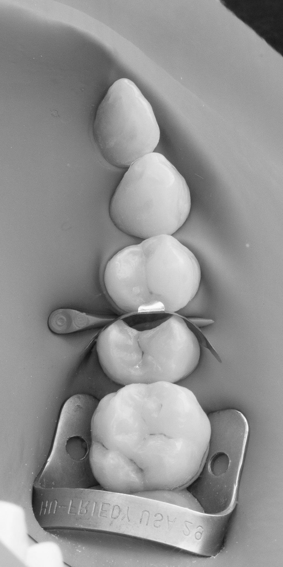 Sequência de dentes com sistema de matriz
